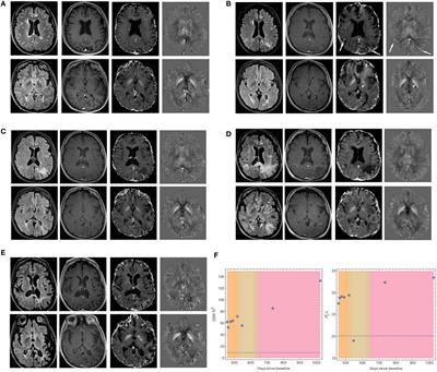 Brain Susceptibility Changes in a Patient with Natalizumab-Related Progressive Multifocal Leukoencephalopathy: A Longitudinal Quantitative Susceptibility Mapping and Relaxometry Study